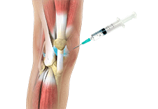 Viscosupplementation (Synvisc) Injection