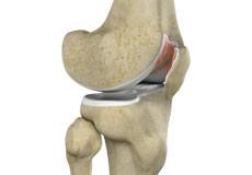 Chondromalacia Patella