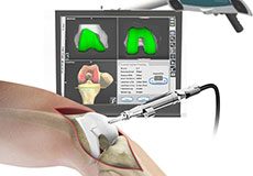 Computer Navigation for Total Knee Replacement