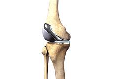 Custom Fitted Total Knee Arthroplasty
