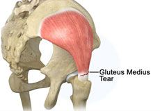 Gluteus Medius Tear