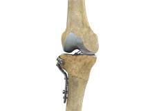 High Tibial Osteotomy