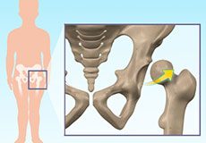 Hip dysplasia