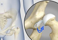 Hip instability