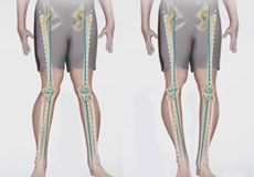 Knee Angular Deformities