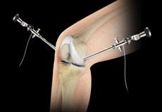 Knee arthroscopy