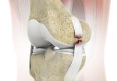 Knee Ligament Reconstruction