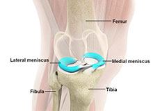 Patella Tendon Rupture or Tear