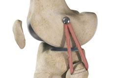 Lateral Collateral Ligament (LCL) Reconstruction