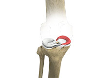 Medial Meniscus Syndrome 