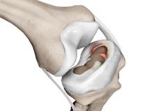 Meniscal Injuries