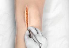 Minimally or Less Invasive Total Knee Arthroplasty