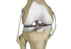 Multi Ligament Knee Reconstruction