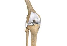 OATS (Osteochondral Autologous Transfer Surgery)