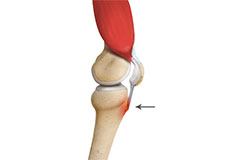 Osgood-Schlatter Disease