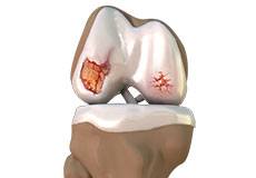 Osteoarthritis Management