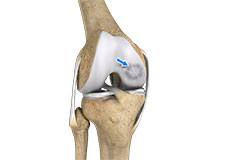 Osteochondritis Dissecans