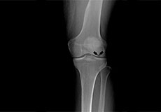 Osteonecrosis of the Knee