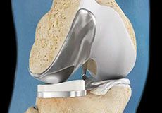 Partial Knee Replacement