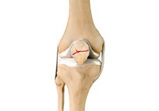 Patella Fracture