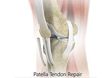 Patella Tendon Repair