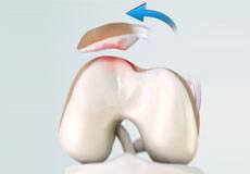 Patellar Dislocation