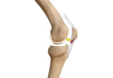 Patellar Tendinitis