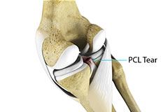 Patellar Dislocation