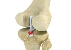 Posterior Cruciate Ligament Tear