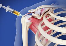 Platelet-rich Plasma Therapy