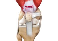 Quadriceps Tendon Rupture