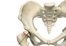 Slipped capital femoral epiphysis