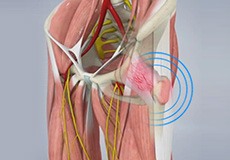 Snapping Hip Syndrome