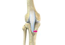 Tibial Tubercule Osteotomy