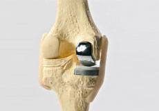 Unicondylar Knee Replacement