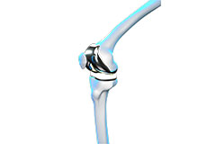 What’s New in Knee Replacement